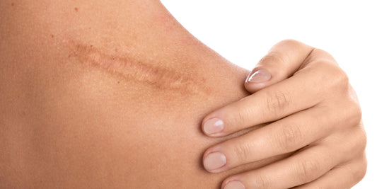 Scar Care 2.0: CBD Cream Post-Surgery to Reduce Redness, Itch & Scar Thickness